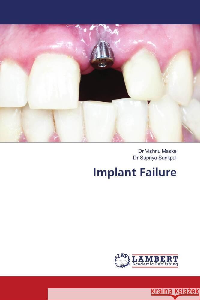 Implant Failure Maske, Dr Vishnu, Sankpal, Dr Supriya 9786204211459 LAP Lambert Academic Publishing - książka