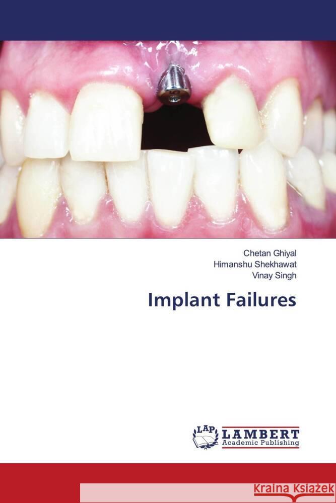 Implant Failures Ghiyal, Chetan, Shekhawat, Himanshu, Singh, Vinay 9783659925276 LAP Lambert Academic Publishing - książka