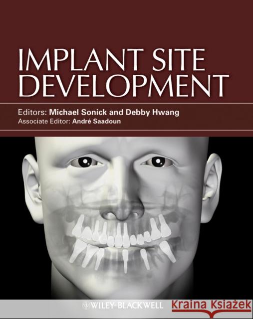 Implant Site Development Michael Sonick 9780813825120 John Wiley & Sons - książka