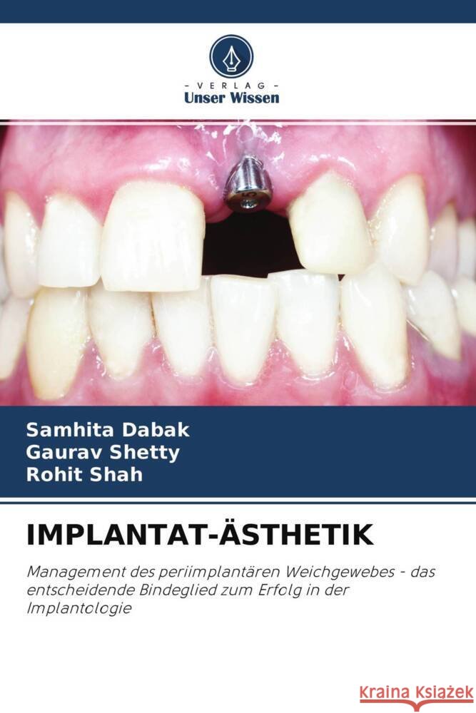 IMPLANTAT-ÄSTHETIK Dabak, Samhita, Shetty, Gaurav, Shah, Rohit 9786204560885 Verlag Unser Wissen - książka