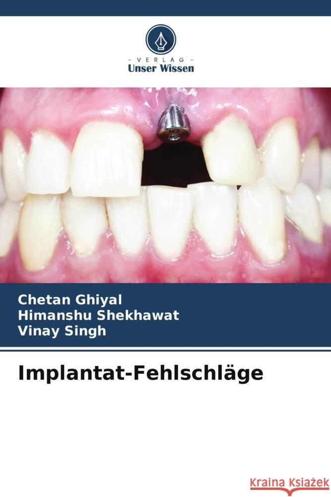 Implantat-Fehlschläge Ghiyal, Chetan, Shekhawat, Himanshu, Singh, Vinay 9786208387105 Verlag Unser Wissen - książka