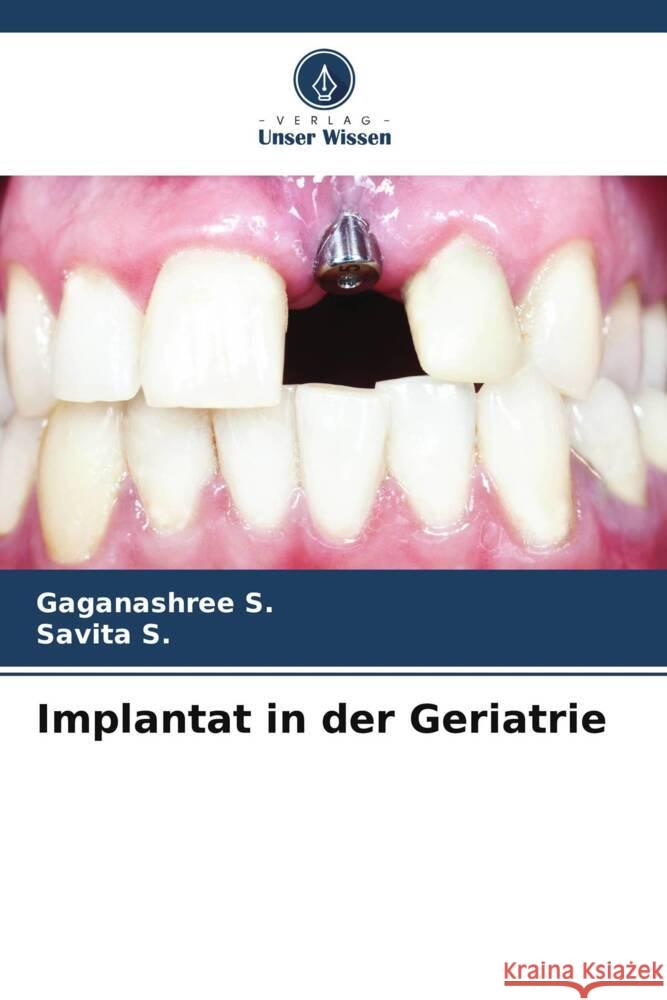 Implantat in der Geriatrie S., Gaganashree, S., Savita 9786206608554 Verlag Unser Wissen - książka