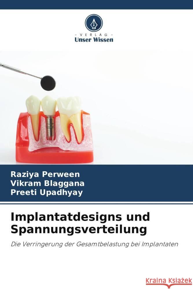 Implantatdesigns und Spannungsverteilung Raziya Perween Vikram Blaggana Preeti Upadhyay 9786206951094 Verlag Unser Wissen - książka