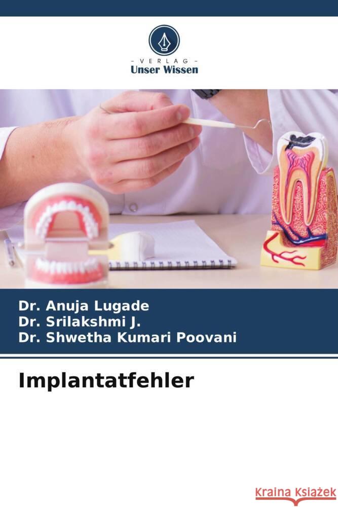 Implantatfehler Anuja Lugade Srilakshmi J Shwetha Kumari Poovani 9786207967438 Verlag Unser Wissen - książka