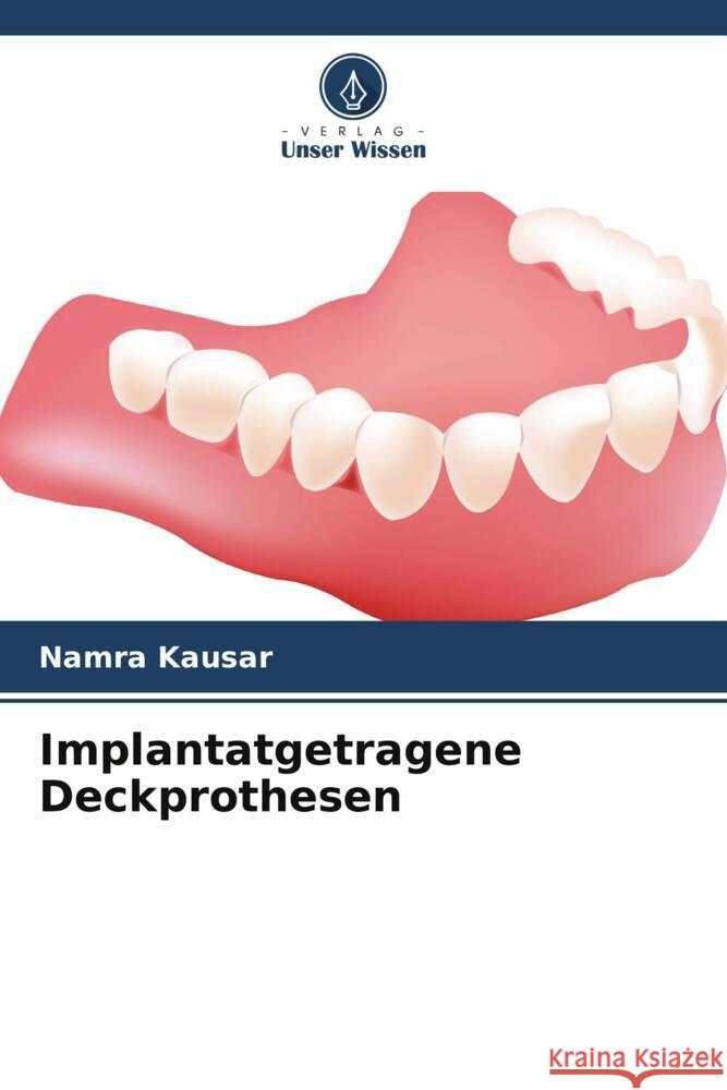 Implantatgetragene Deckprothesen Namra Kausar   9786206243083 Verlag Unser Wissen - książka