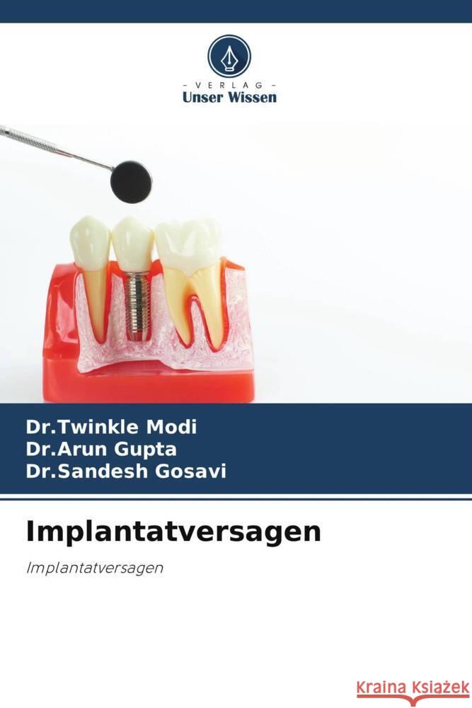 Implantatversagen Dr Twinkle Modi Dr Arun Gupta Dr Sandesh Gosavi 9786207430581 Verlag Unser Wissen - książka