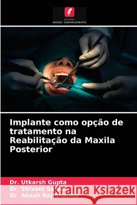 Implante como opção de tratamento na Reabilitação da Maxila Posterior Dr Utkarsh Gupta, Dr Shivani Saran, Dr Akash Raj Sharma 9786204032399 Edicoes Nosso Conhecimento - książka