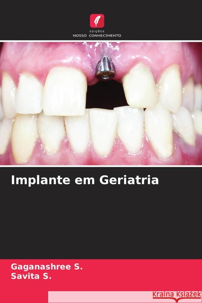 Implante em Geriatria S., Gaganashree, S., Savita 9786206608547 Edições Nosso Conhecimento - książka