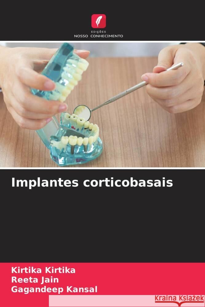 Implantes corticobasais Kirtika, Kirtika, Jain, Reeta, Kansal, Gagandeep 9786208347611 Edições Nosso Conhecimento - książka