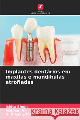 Implantes dentários em maxilas e mandíbulas atrofiadas Singh, Ishita, V., Madhuri, Kumar, U. Krishna 9786203919349 Edições Nosso Conhecimento - książka