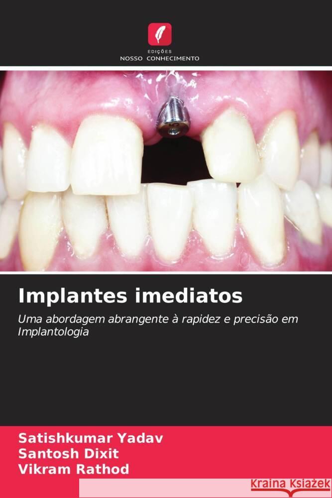 Implantes imediatos Satishkumar Yadav Santosh Dixit Vikram Rathod 9786208060442 Edicoes Nosso Conhecimento - książka