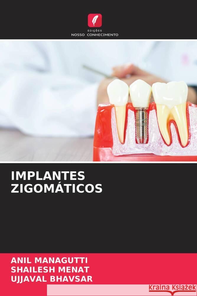 IMPLANTES ZIGOMÁTICOS Managutti, Anil, Menat, Shailesh, Bhavsar, Ujjaval 9786205021361 Edições Nosso Conhecimento - książka