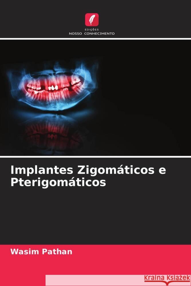 Implantes Zigomáticos e Pterigomáticos Pathan, Wasim 9786205164846 Edições Nosso Conhecimento - książka