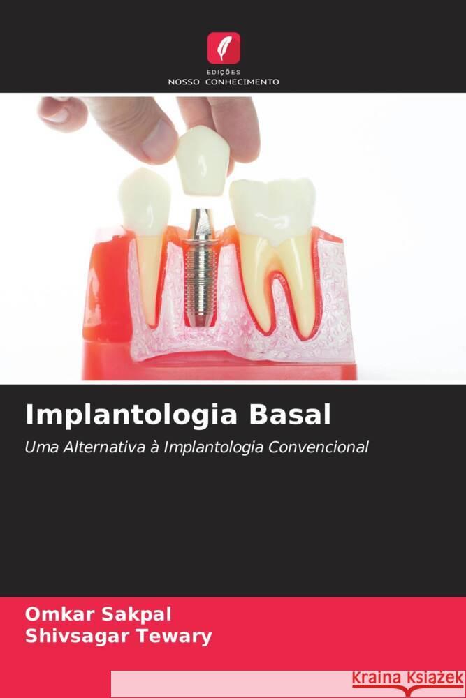 Implantologia Basal Sakpal, Omkar, Tewary, Shivsagar 9786202981774 Edições Nosso Conhecimento - książka