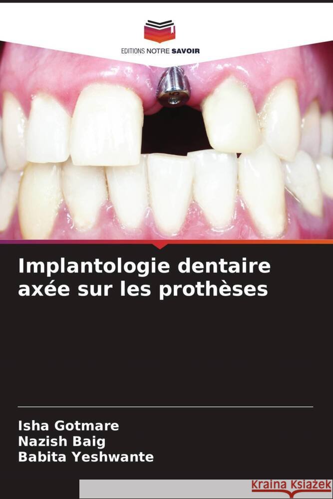Implantologie dentaire axée sur les prothèses Gotmare, Isha, Baig, Nazish, Yeshwante, Babita 9786207077908 Editions Notre Savoir - książka