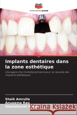 Implants dentaires dans la zone esthétique Amrulla, Shaik, Rao, Anupama, Hegde, Shashikanth 9786209068232 Editions Notre Savoir - książka