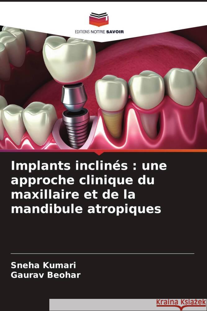 Implants inclin?s: une approche clinique du maxillaire et de la mandibule atropiques Sneha Kumari Gaurav Beohar 9786206903734 Editions Notre Savoir - książka