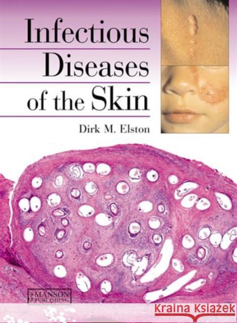 Infectious Diseases of the Skin Dirk M Elston 9781840761771  - książka