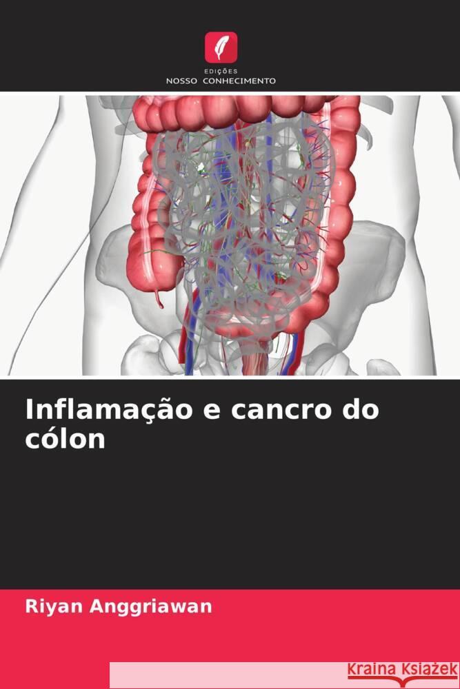 Inflama??o e cancro do c?lon Riyan Anggriawan 9786206620426 Edicoes Nosso Conhecimento - książka