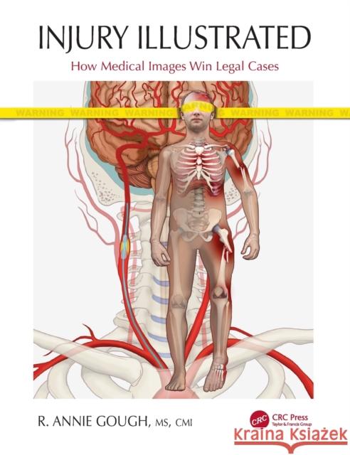 Injury Illustrated: How Medical Images Win Legal Cases R. Annie Gough 9780367524173 CRC Press - książka