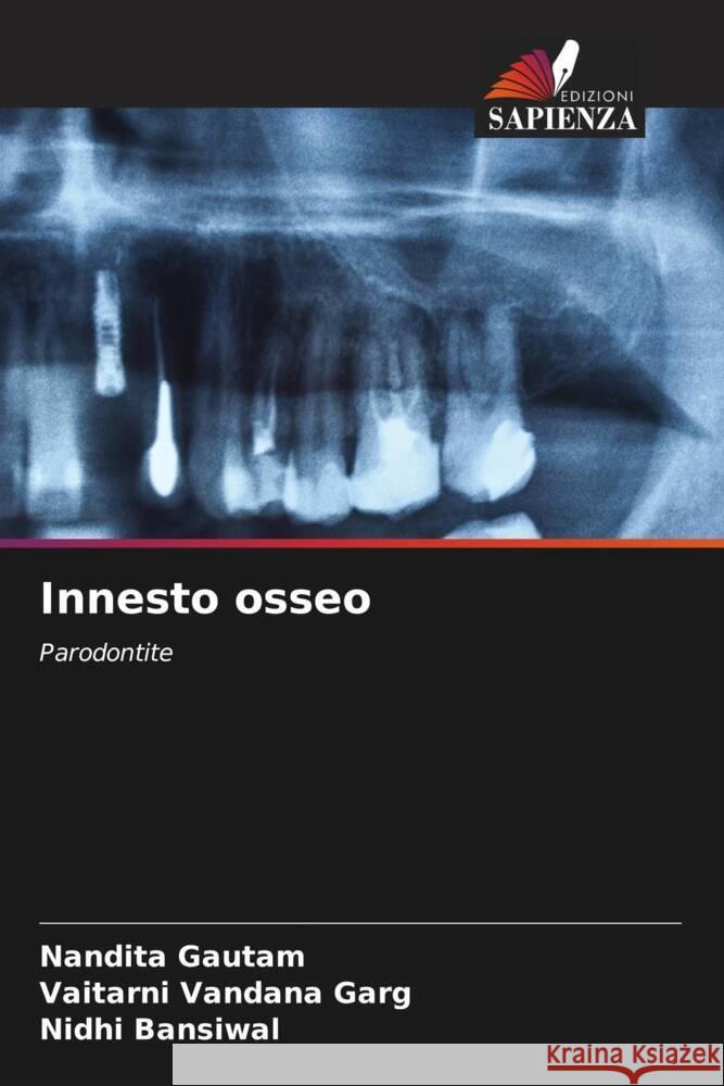 Innesto osseo Gautam, Nandita, Garg, Vaitarni Vandana, Bansiwal, Nidhi 9786205051160 Edizioni Sapienza - książka