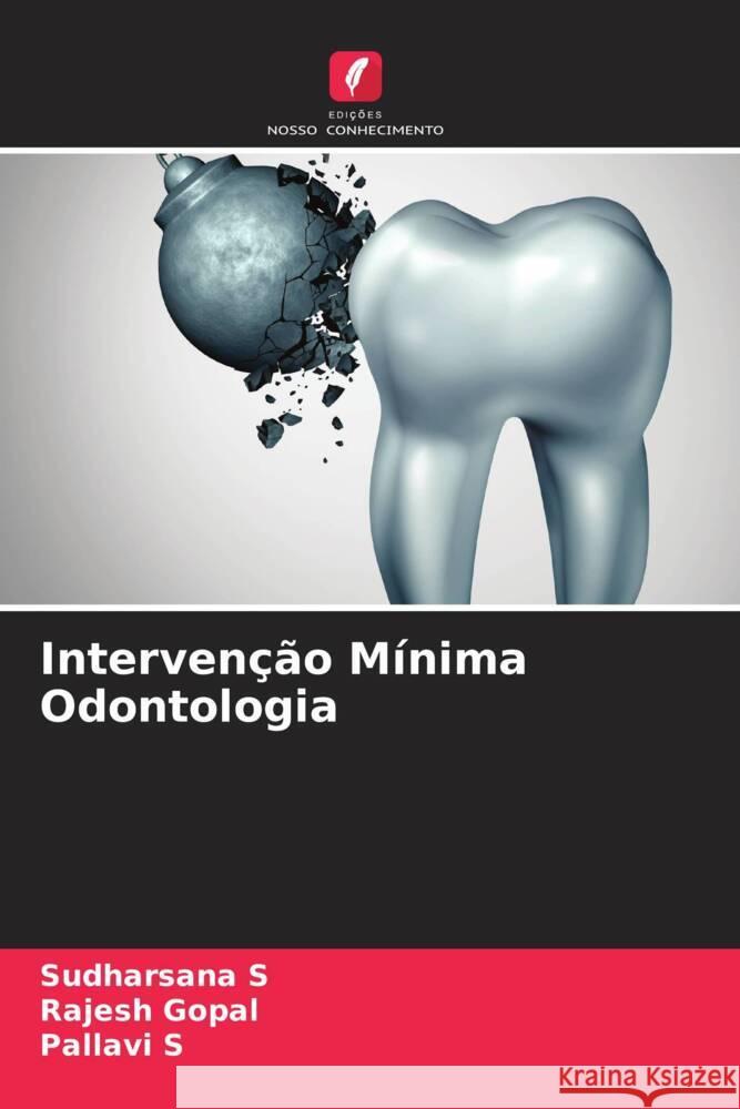 Intervenção Mínima Odontologia S, Sudharsana, Gopal, Rajesh, S, Pallavi 9786204411125 Edicoes Nosso Conhecimento - książka