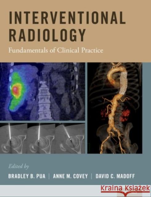 Interventional Radiology: Fundamentals of Clinical Practice Bradley B. Pua Anne M. Covey David C. Madoff 9780190276249 Oxford University Press, USA - książka