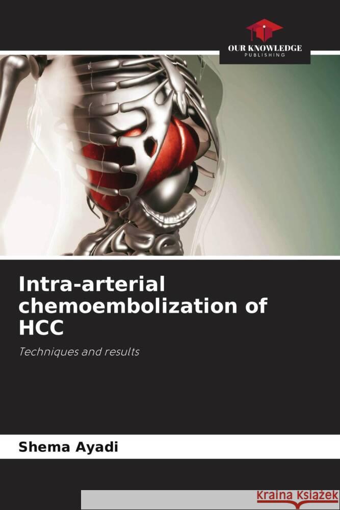 Intra-arterial chemoembolization of HCC Ayadi, Shema 9786206325130 Our Knowledge Publishing - książka