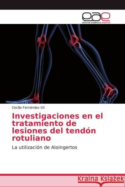 Investigaciones en el tratamiento de lesiones del tendón rotuliano : La utilización de Aloingertos Fernández Gil, Cecilia 9786202137171 Editorial Académica Española - książka