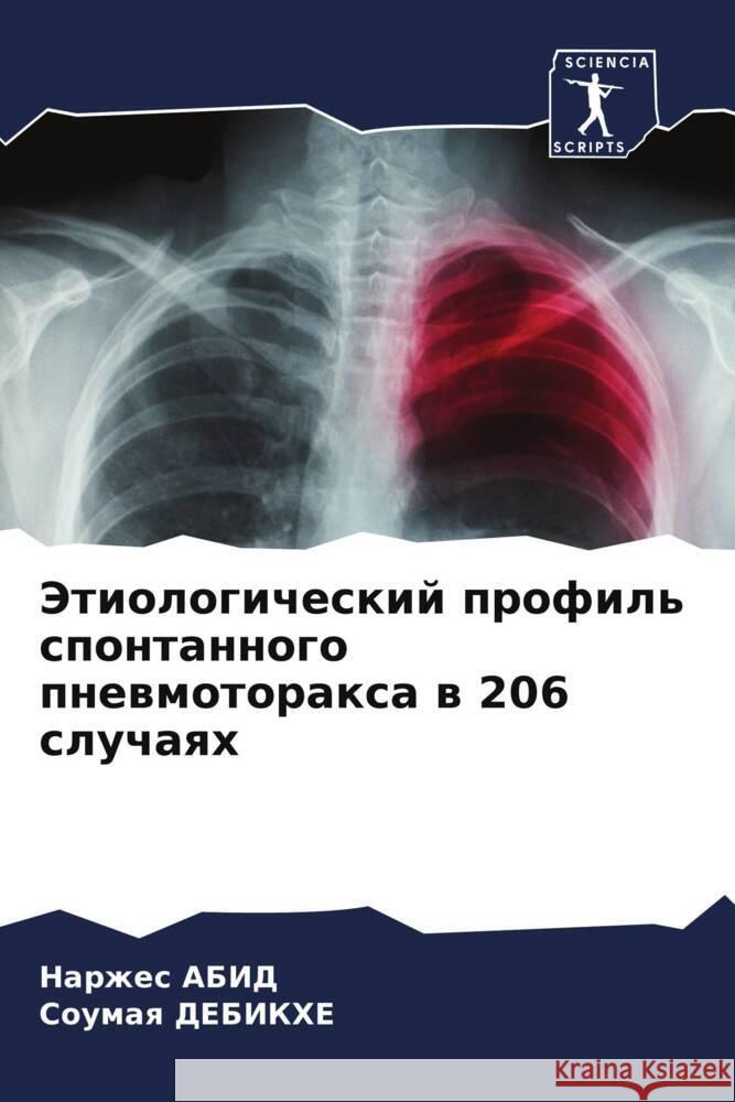 Jetiologicheskij profil' spontannogo pnewmotoraxa w 206 sluchaqh ABID, Narzhes, DEBIKHE, Soumaq 9786208382544 Sciencia Scripts - książka