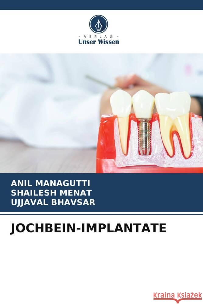 JOCHBEIN-IMPLANTATE Managutti, Anil, Menat, Shailesh, Bhavsar, Ujjaval 9786205021316 Verlag Unser Wissen - książka