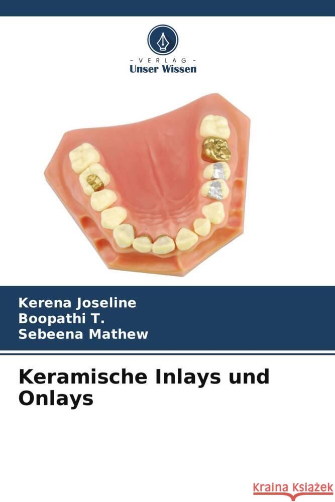 Keramische Inlays und Onlays Kerena Joseline Boopathi T Sebeena Mathew 9786206974826 Verlag Unser Wissen - książka