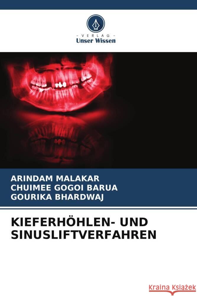 KIEFERHÖHLEN- UND SINUSLIFTVERFAHREN Malakar, Arindam, Barua, Chuimee Gogoi, BHARDWAJ, GOURIKA 9786207095766 Verlag Unser Wissen - książka