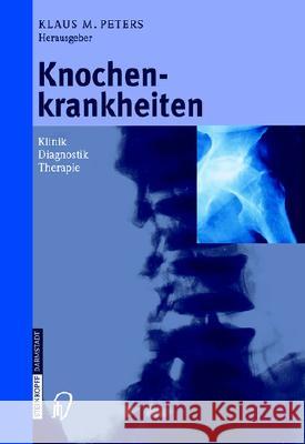 Knochenkrankheiten: Klinik Diagnose Therapie Klaus M. Peters P. Eysel 9783798513259 Steinkopff-Verlag Darmstadt - książka