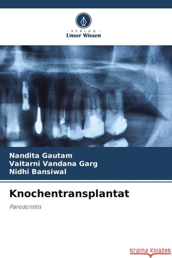 Knochentransplantat Gautam, Nandita, Garg, Vaitarni Vandana, Bansiwal, Nidhi 9786205051139 Verlag Unser Wissen - książka