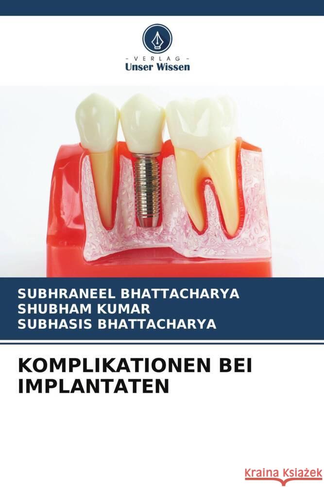 KOMPLIKATIONEN BEI IMPLANTATEN BHATTACHARYA, SUBHRANEEL, Kumar, Shubham, Bhattacharya, Subhasis 9786208198930 Verlag Unser Wissen - książka