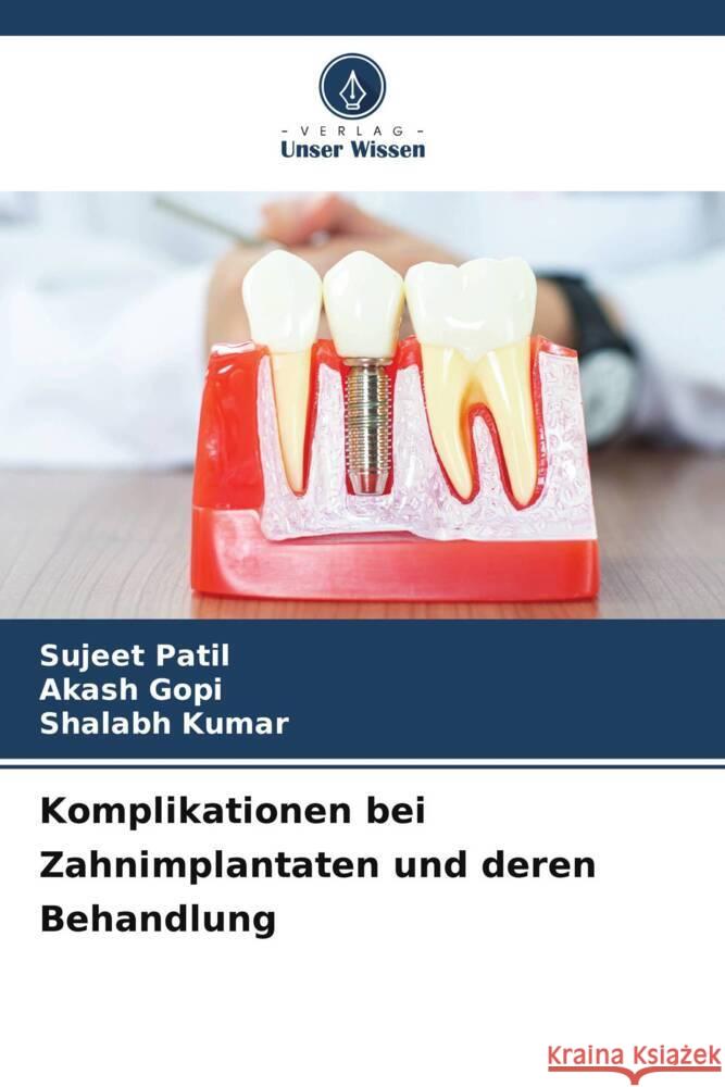 Komplikationen bei Zahnimplantaten und deren Behandlung Sujeet Patil Akash Gopi Shalabh Kumar 9786207225576 Verlag Unser Wissen - książka