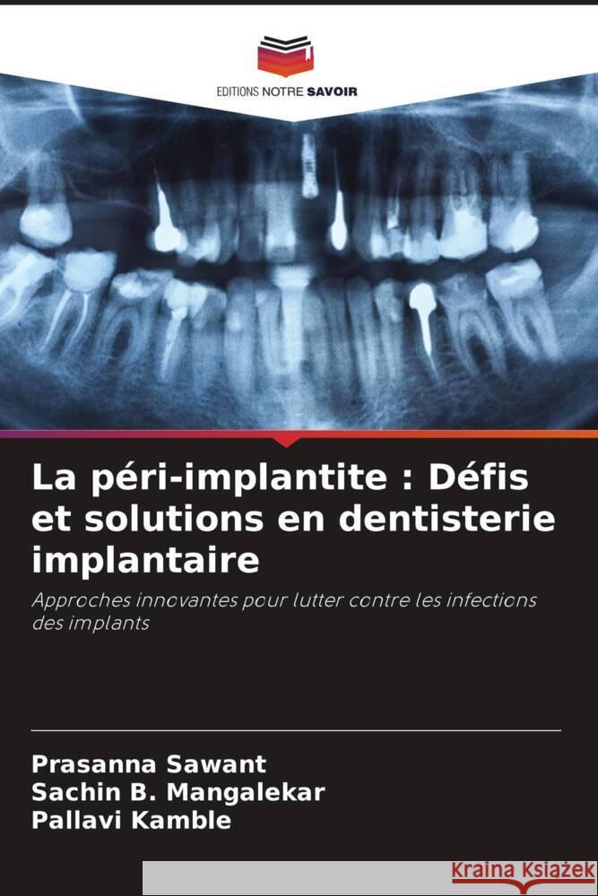 La p?ri-implantite: D?fis et solutions en dentisterie implantaire Prasanna Sawant Sachin B. Mangalekar Pallavi Kamble 9786208611569 Editions Notre Savoir - książka