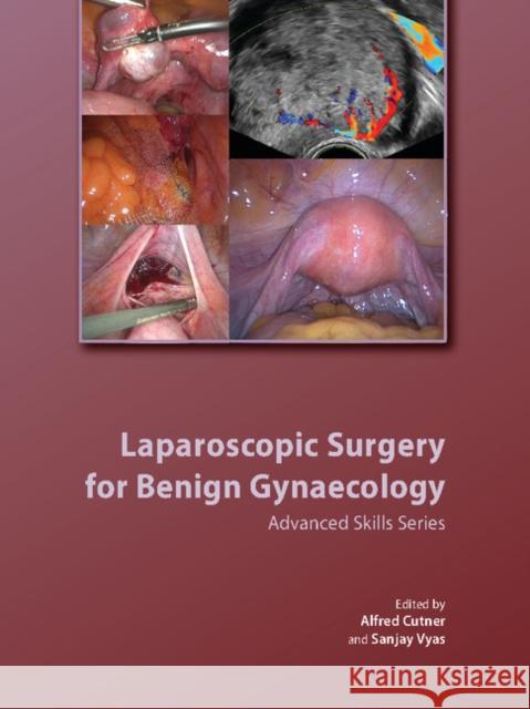 Laparoscopic Surgery for Benign Gynaecology Hardback with DVDs [With DVD] Cutner, Alfred 9781906985318 RCOG Press - książka