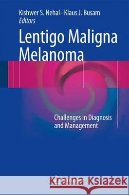 Lentigo Maligna Melanoma: Challenges in Diagnosis and Management Nehal, Kishwer S. 9783319437859 Springer - książka