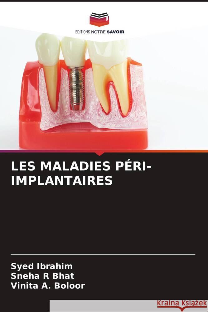 Les Maladies P?ri-Implantaires Syed Ibrahim Sneha R. Bhat Vinita A. Boloor 9786207339624 Editions Notre Savoir - książka