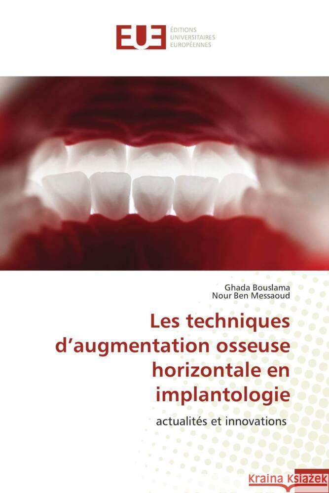 Les techniques d'augmentation osseuse horizontale en implantologie Bouslama, Ghada, Ben Messaoud, Nour 9786206722922 Éditions universitaires européennes - książka