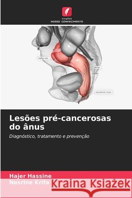 Lesões pré-cancerosas do ânus Hassine, Hajer, Krifa, Nesrine 9786209116117 Edições Nosso Conhecimento - książka
