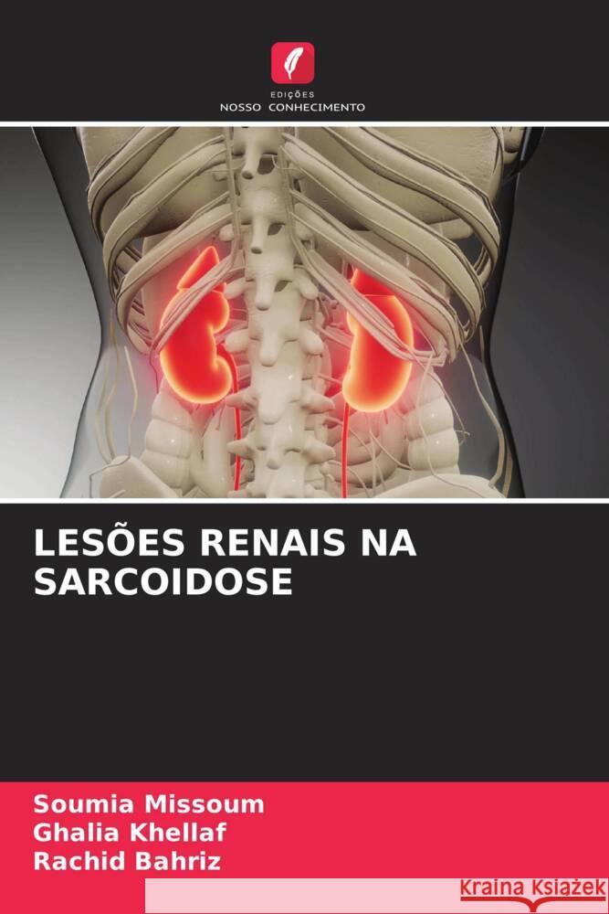 Les?es Renais Na Sarcoidose Soumia Missoum Ghalia Khellaf Rachid Bahriz 9786206901082 Edicoes Nosso Conhecimento - książka