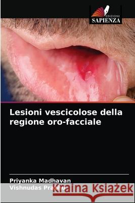 Lesioni vescicolose della regione oro-facciale Priyanka Madhavan Vishnudas Prabhu 9786204087023 Edizioni Sapienza - książka