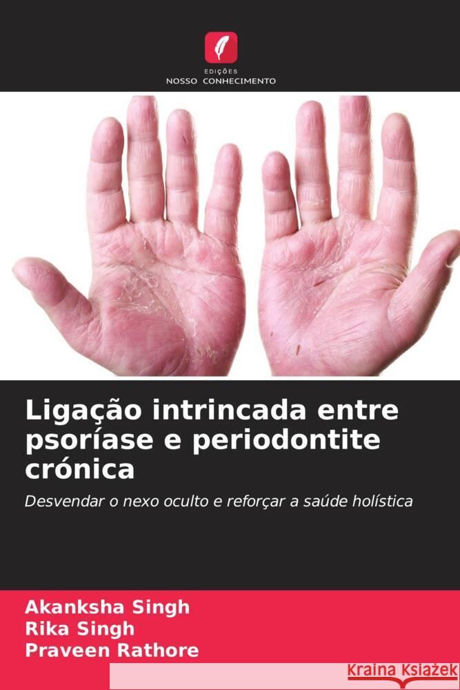 Ligação intrincada entre psoríase e periodontite crónica Singh, Akanksha, Singh, Rika, Rathore, Praveen 9786208249588 Edições Nosso Conhecimento - książka