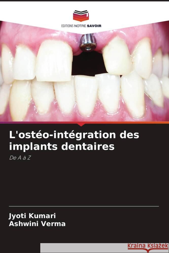 L\'ost?o-int?gration des implants dentaires Jyoti Kumari Ashwini Verma 9786205712498 Editions Notre Savoir - książka