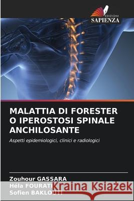 MALATTIA DI FORESTER O IPEROSTOSI SPINALE ANCHILOSANTE Gassara, Zouhour, Fourati, Hela, Baklouti, Sofien 9783639814620 Edizioni Sapienza - książka