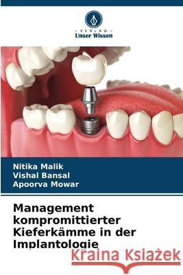 Management kompromittierter Kieferk?mme in der Implantologie Nitika Malik Vishal Bansal Apoorva Mowar 9786207690879 Verlag Unser Wissen - książka