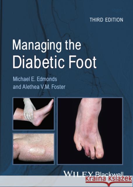 Managing the Diabetic Foot Michael E. Edmonds Alethea V.M. Foster  9780470655054  - książka